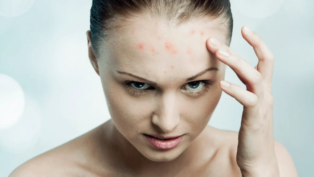 My fight with problematic facial skin